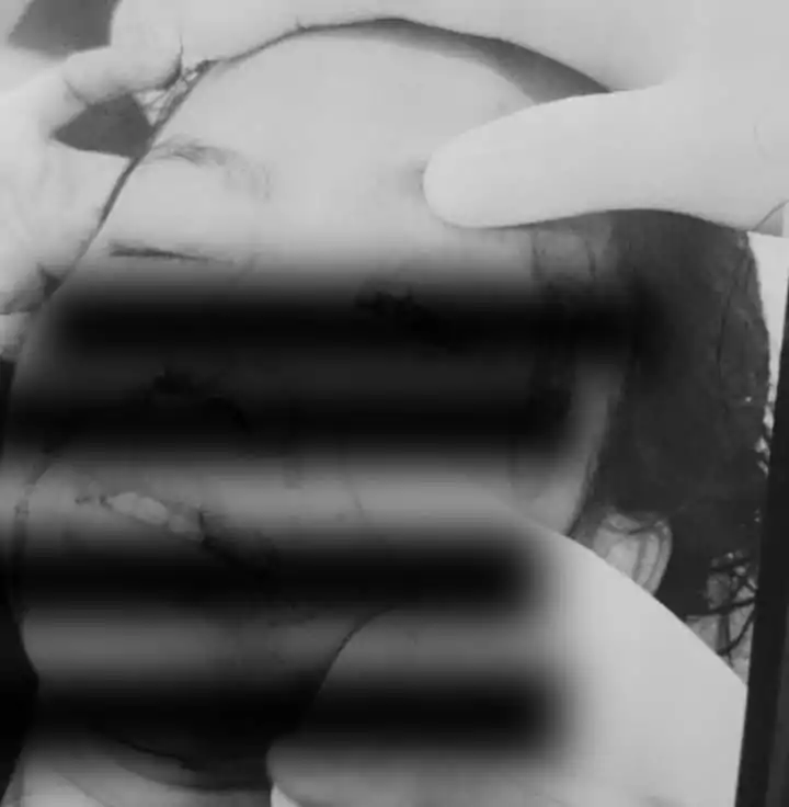 Mata Wanita Warga Sawangan Ini Buta Permanen Sebelah Kiri, Usai KDRT dari Suaminya 